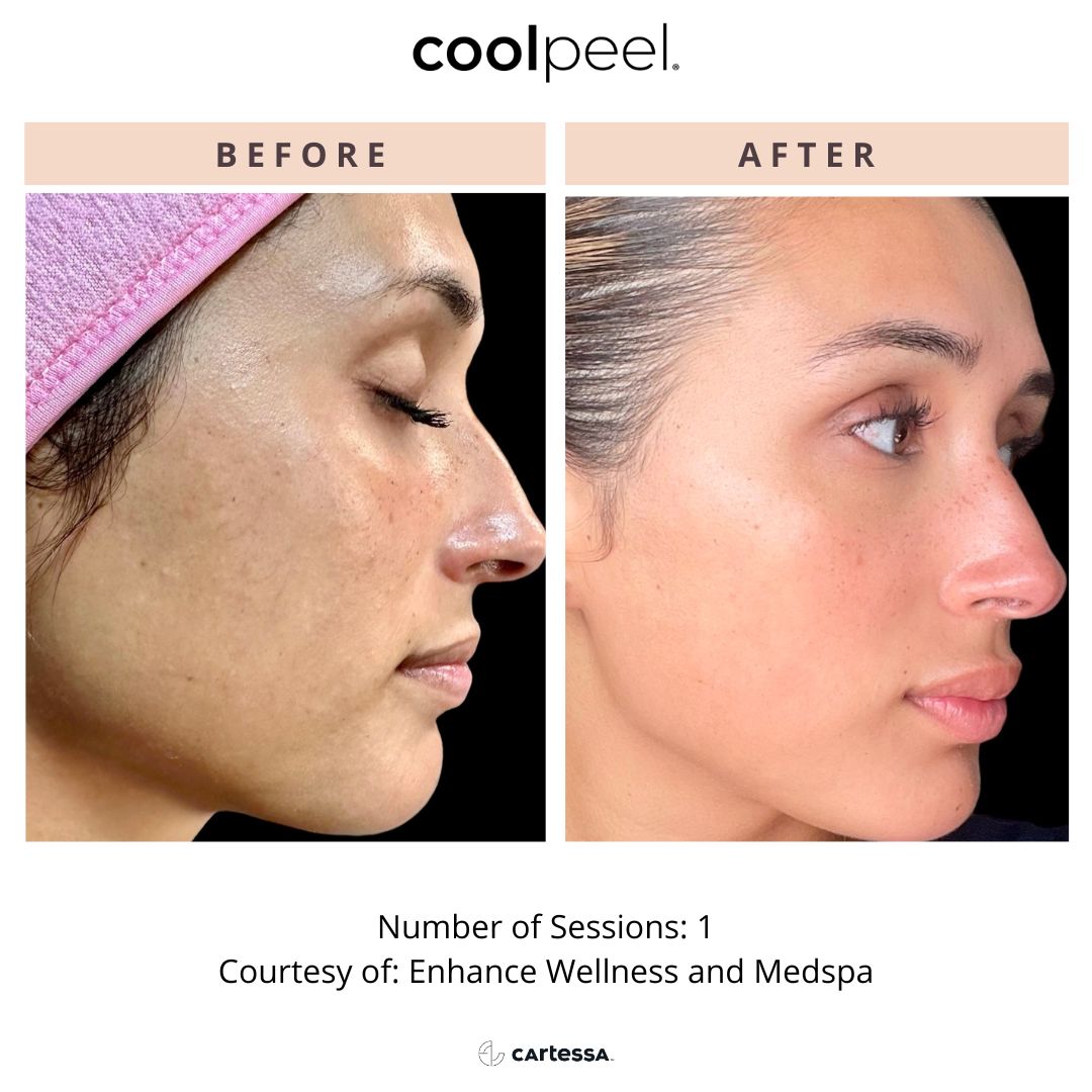 coolpeel tetra pro services Doylestown